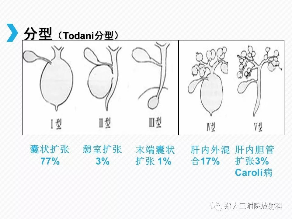 【PPT】小儿先天性胆总管囊肿CT诊断