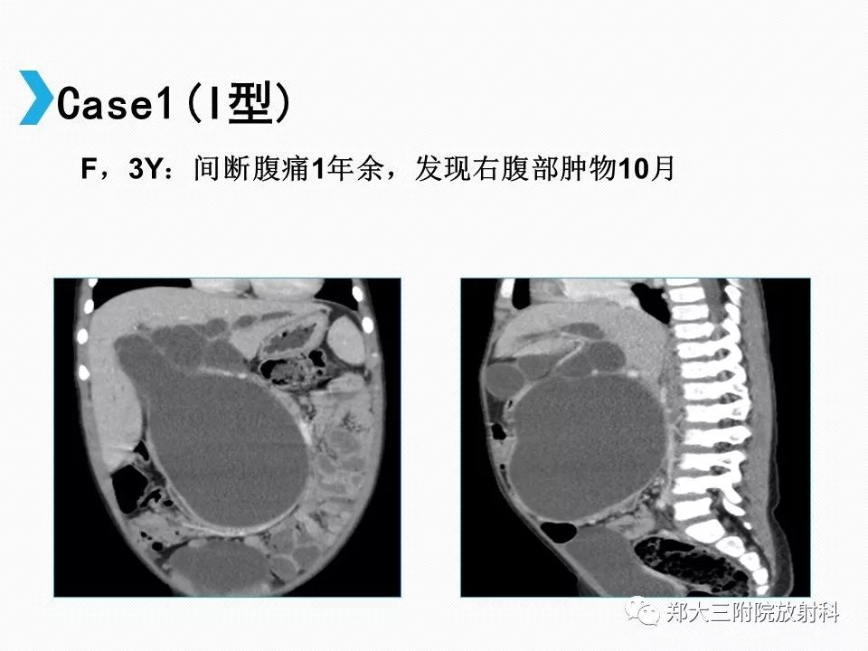 【PPT】小儿先天性胆总管囊肿CT诊断