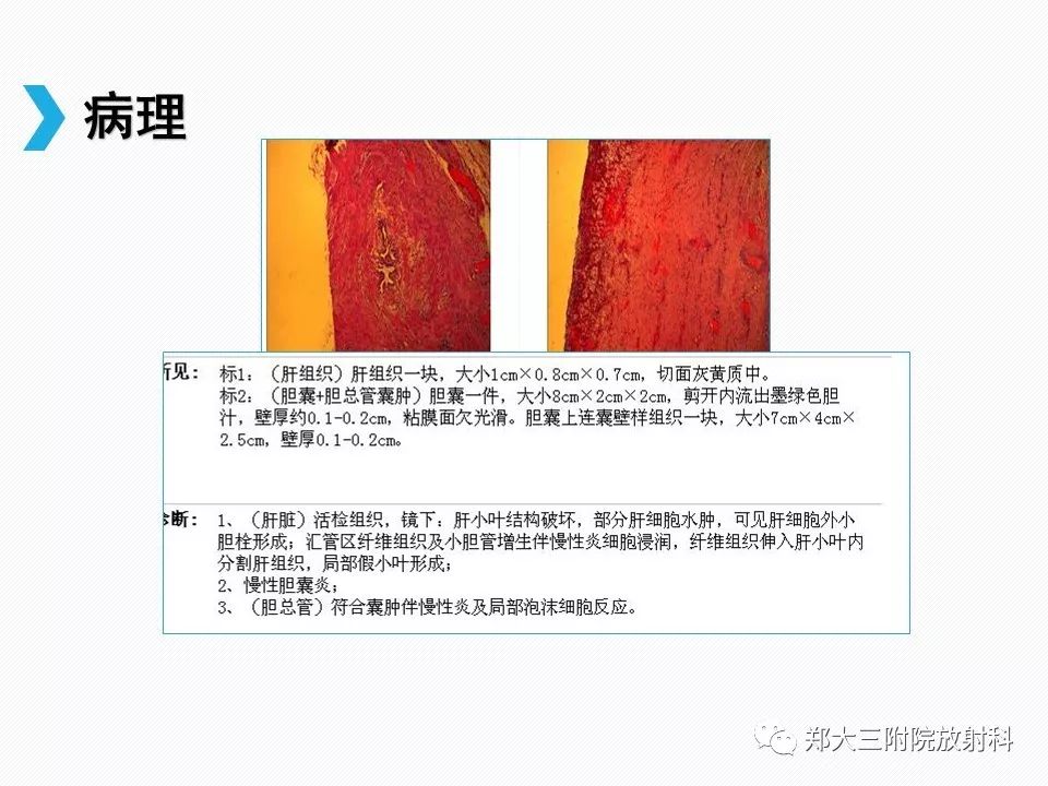 【PPT】小儿先天性胆总管囊肿CT诊断
