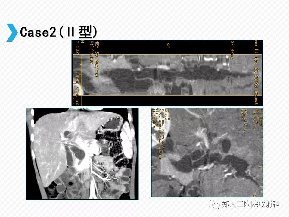 【PPT】小儿先天性胆总管囊肿CT诊断
