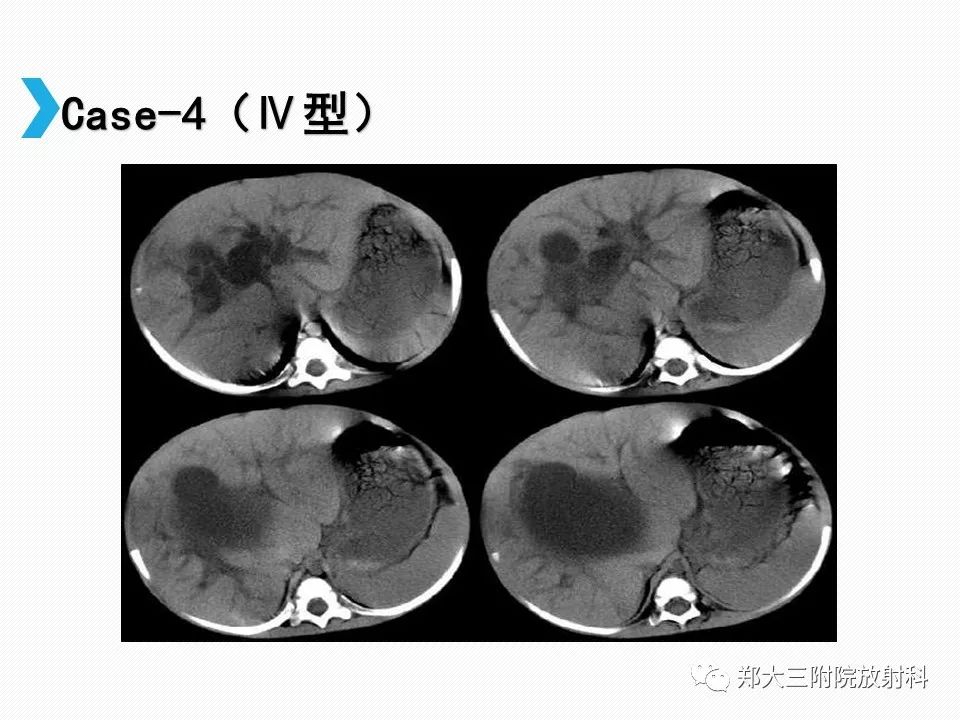 【PPT】小儿先天性胆总管囊肿CT诊断