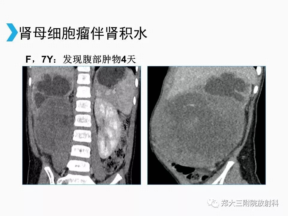 【PPT】小儿先天性胆总管囊肿CT诊断