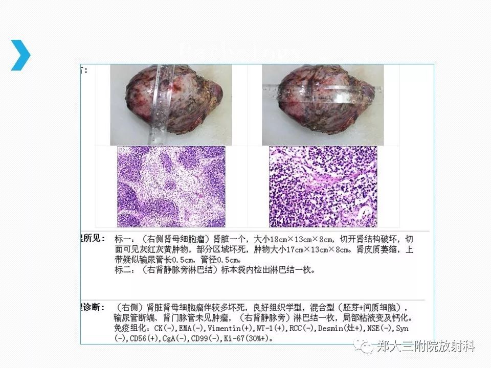 【PPT】小儿先天性胆总管囊肿CT诊断