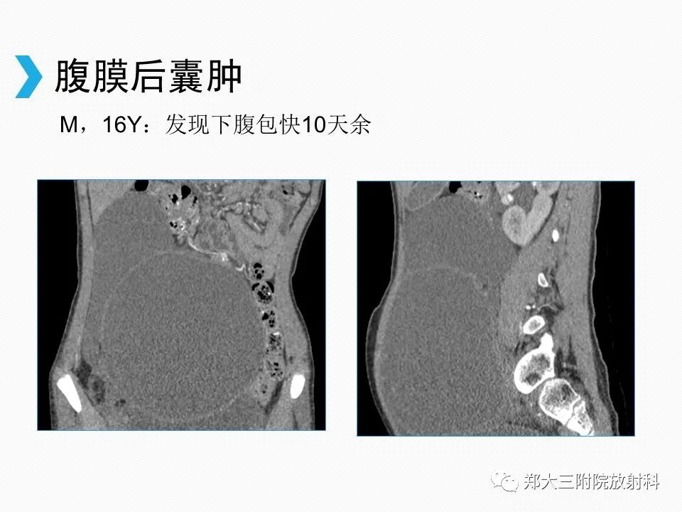 【PPT】小儿先天性胆总管囊肿CT诊断