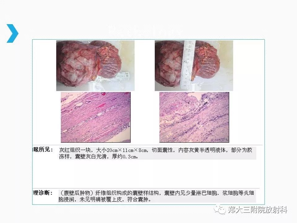 【PPT】小儿先天性胆总管囊肿CT诊断