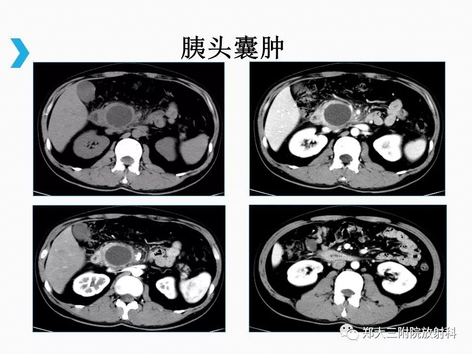 【PPT】小儿先天性胆总管囊肿CT诊断