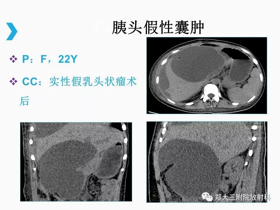 【PPT】小儿先天性胆总管囊肿CT诊断