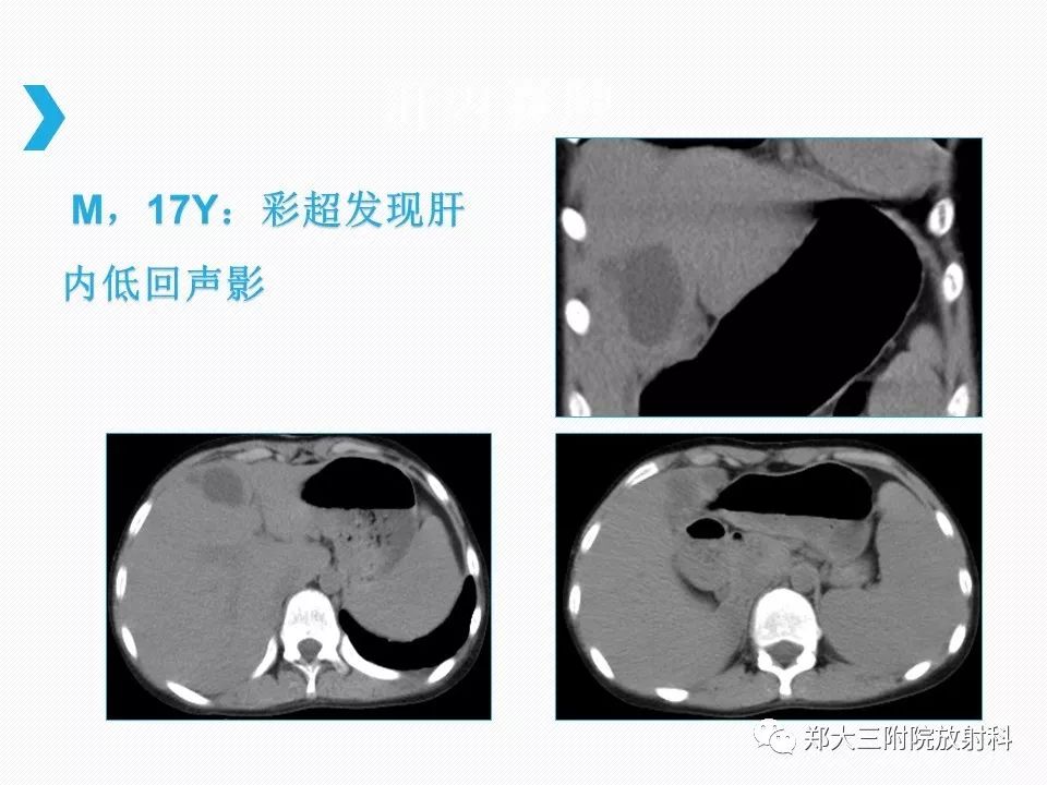 【PPT】小儿先天性胆总管囊肿CT诊断