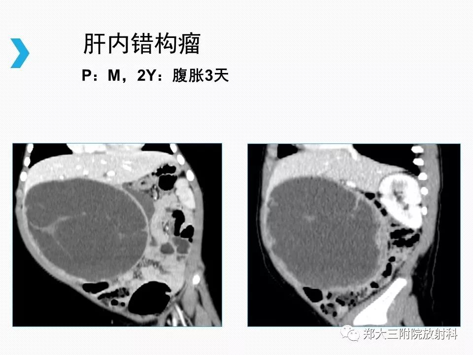 【PPT】小儿先天性胆总管囊肿CT诊断