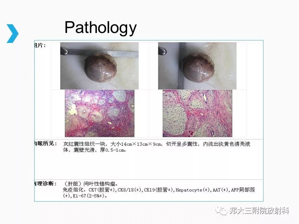 【PPT】小儿先天性胆总管囊肿CT诊断