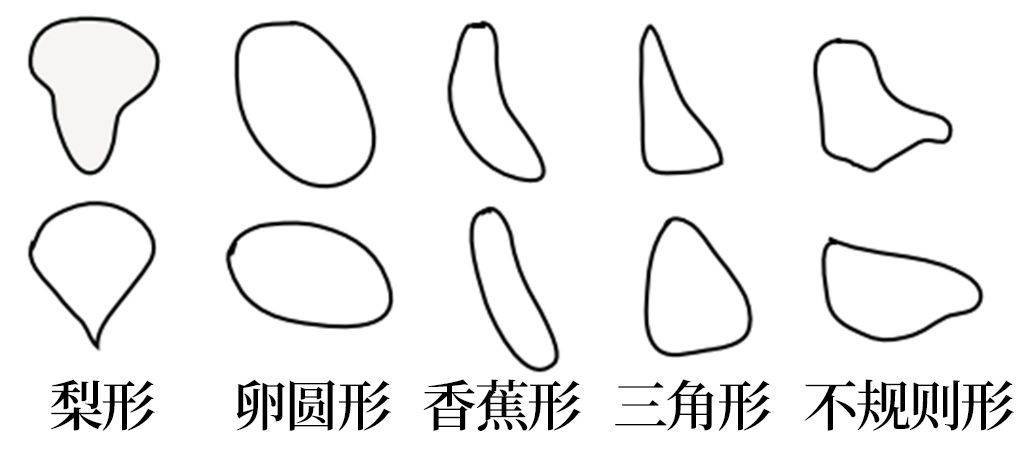 这 4 个男性患者因泌尿系统症状来诊,原因竟是…… 这 4 个男性患者因泌尿系统症状来诊,原因竟是……