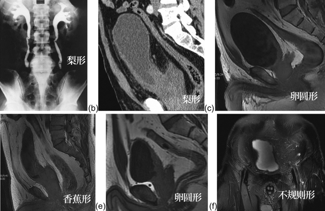这 4 个男性患者因泌尿系统症状来诊,原因竟是…… 这 4 个男性患者因泌尿系统症状来诊,原因竟是……