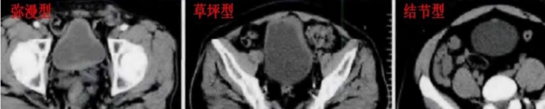 这 4 个男性患者因泌尿系统症状来诊,原因竟是…… 这 4 个男性患者因泌尿系统症状来诊,原因竟是……