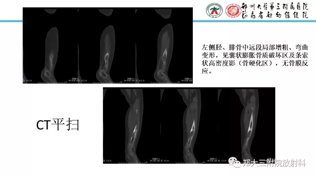 【病例】儿童胫腓骨骨纤维结构不良1例X线CT及MR影像