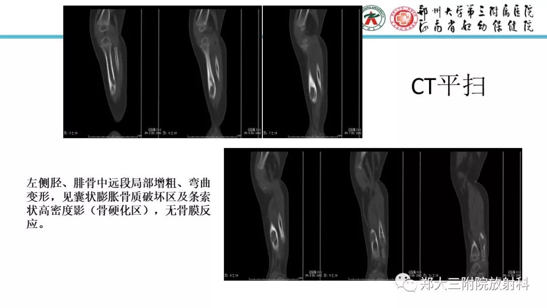 【病例】儿童胫腓骨骨纤维结构不良1例X线CT及MR影像