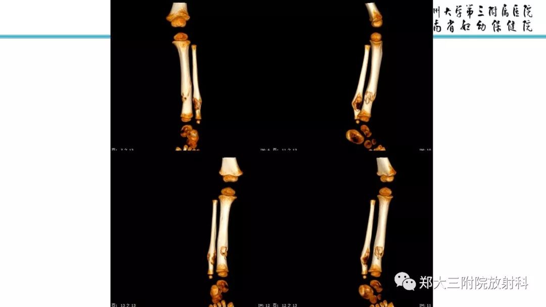 【病例】儿童胫腓骨骨纤维结构不良1例X线CT及MR影像