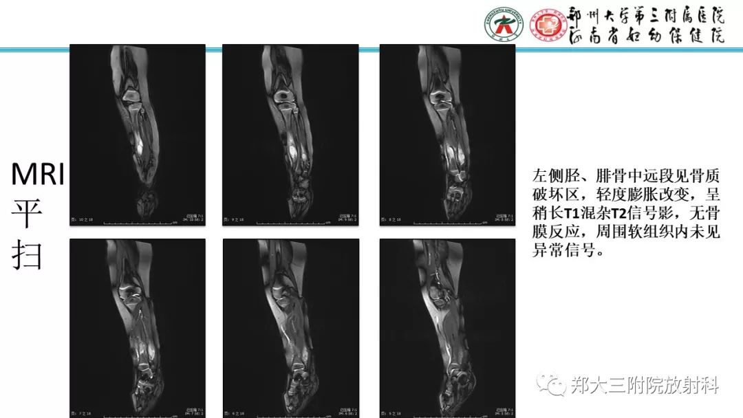 【病例】儿童胫腓骨骨纤维结构不良1例X线CT及MR影像