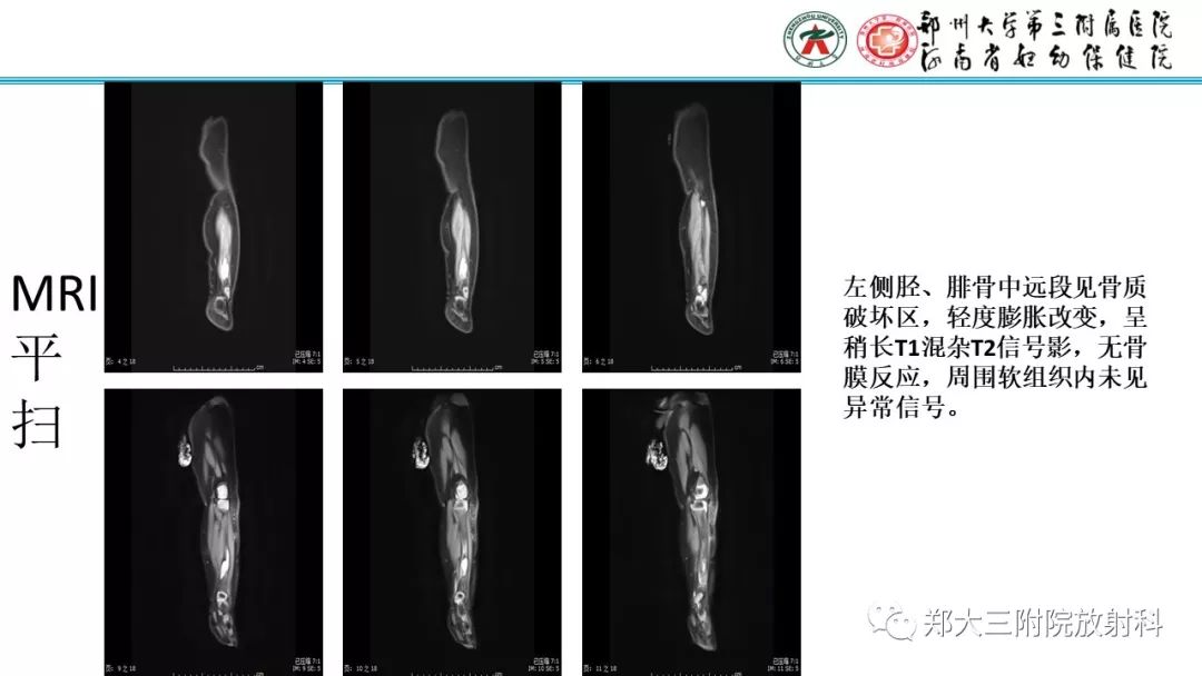 【病例】儿童胫腓骨骨纤维结构不良1例X线CT及MR影像