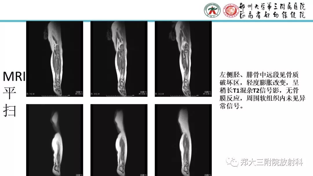 【病例】儿童胫腓骨骨纤维结构不良1例X线CT及MR影像