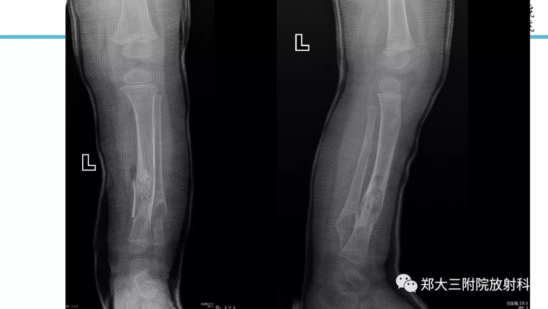 【病例】儿童胫腓骨骨纤维结构不良1例X线CT及MR影像