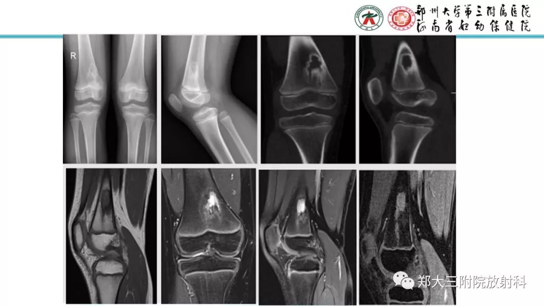 【病例】儿童胫腓骨骨纤维结构不良1例X线CT及MR影像