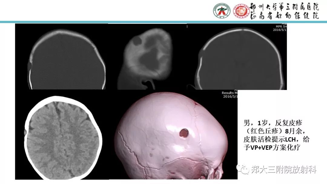 【病例】儿童胫腓骨骨纤维结构不良1例X线CT及MR影像