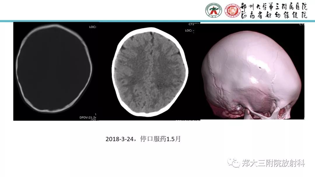 【病例】儿童胫腓骨骨纤维结构不良1例X线CT及MR影像