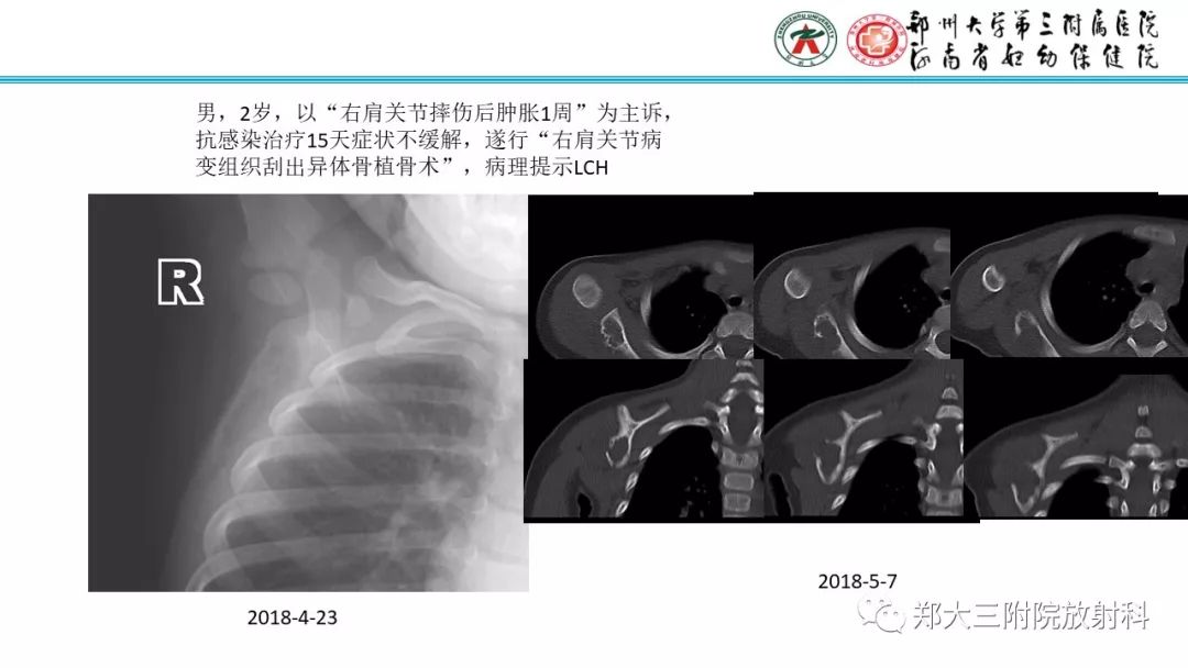 【病例】儿童胫腓骨骨纤维结构不良1例X线CT及MR影像