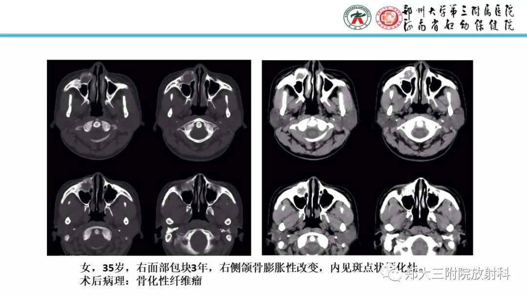【病例】儿童胫腓骨骨纤维结构不良1例X线CT及MR影像