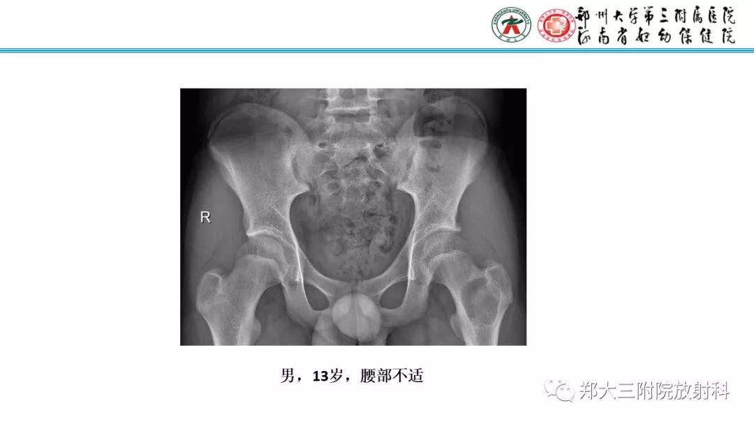 【病例】儿童胫腓骨骨纤维结构不良1例X线CT及MR影像