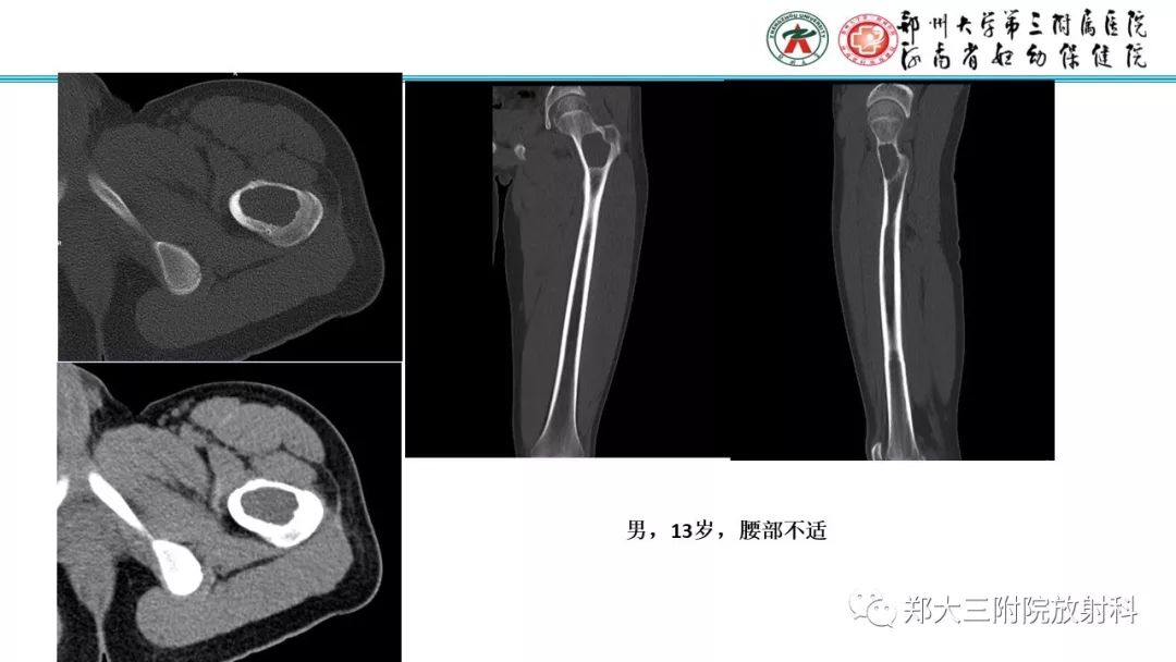 【病例】儿童胫腓骨骨纤维结构不良1例X线CT及MR影像