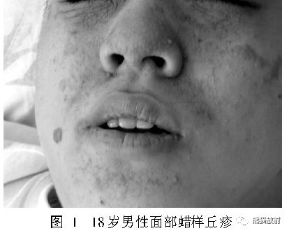 结节性硬化症多系统损害影像表现与诊断 结节性硬化症多系统损害影像表现与诊断