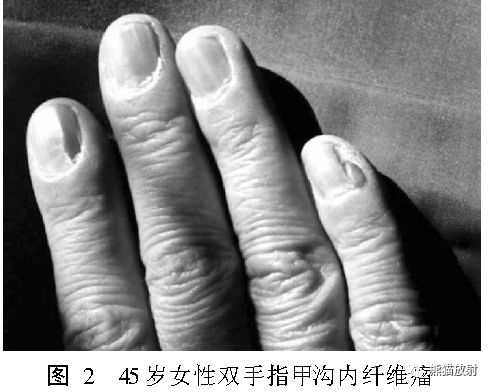 结节性硬化症多系统损害影像表现与诊断 结节性硬化症多系统损害影像表现与诊断