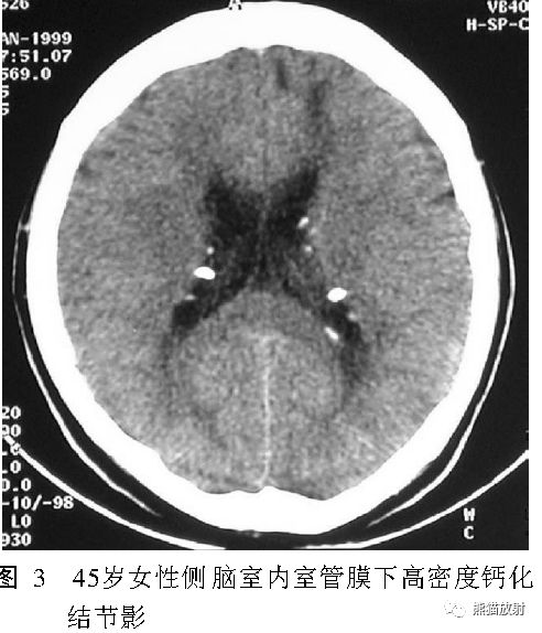 结节性硬化症多系统损害影像表现与诊断 结节性硬化症多系统损害影像表现与诊断