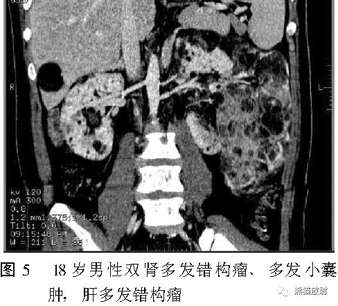 结节性硬化症多系统损害影像表现与诊断 结节性硬化症多系统损害影像表现与诊断