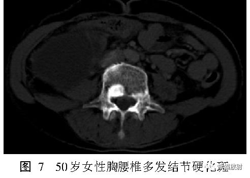 结节性硬化症多系统损害影像表现与诊断 结节性硬化症多系统损害影像表现与诊断