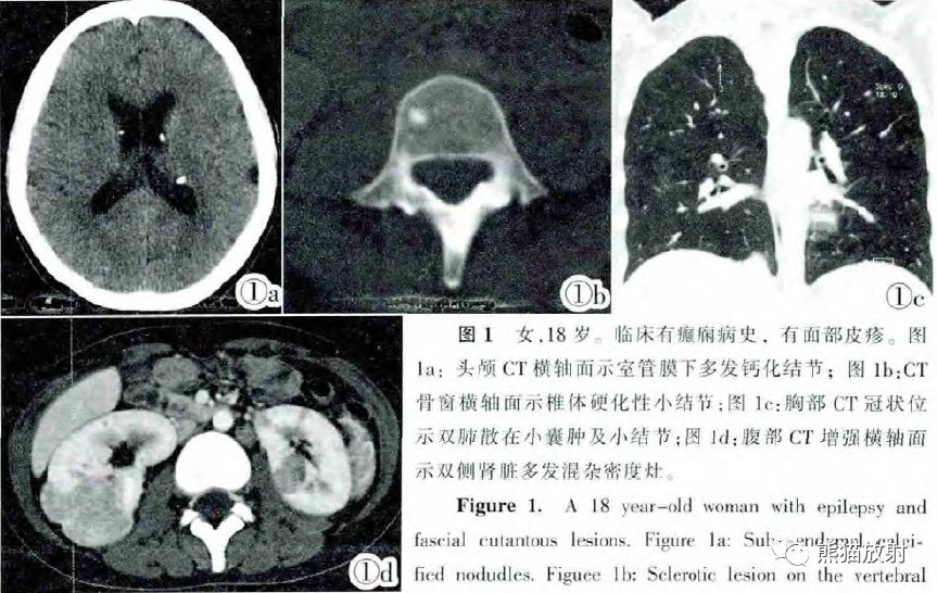结节性硬化症多系统损害影像表现与诊断 结节性硬化症多系统损害影像表现与诊断