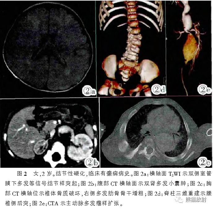 结节性硬化症多系统损害影像表现与诊断 结节性硬化症多系统损害影像表现与诊断