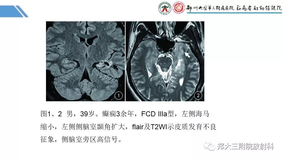 【PPT】局灶性脑皮层发育不良（FCD）