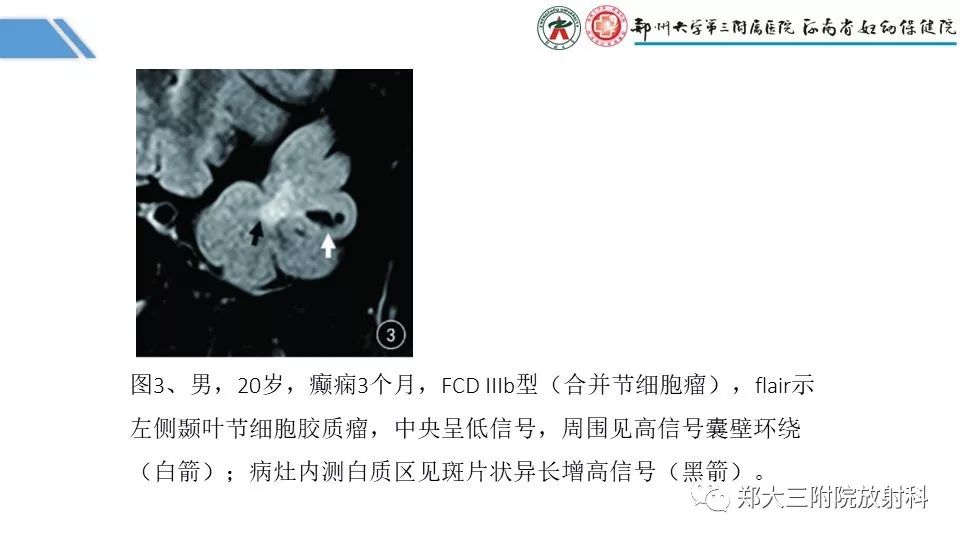 【PPT】局灶性脑皮层发育不良（FCD）