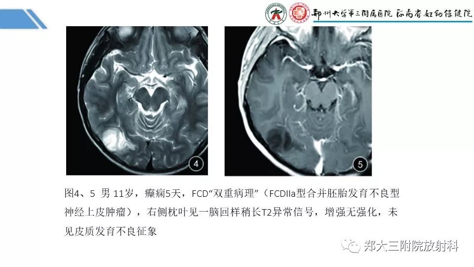 【PPT】局灶性脑皮层发育不良（FCD）