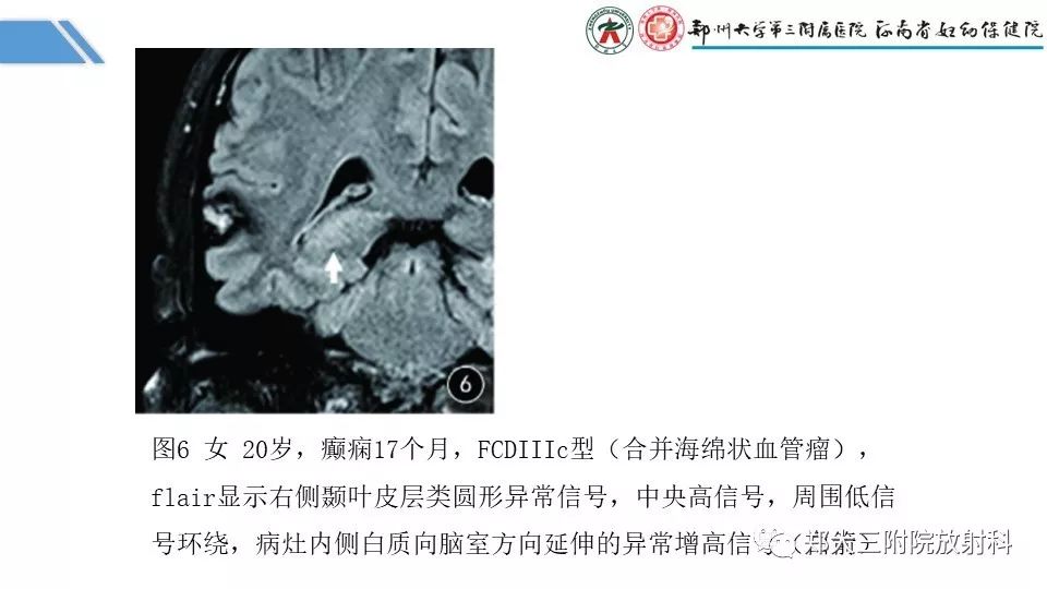 【PPT】局灶性脑皮层发育不良（FCD）