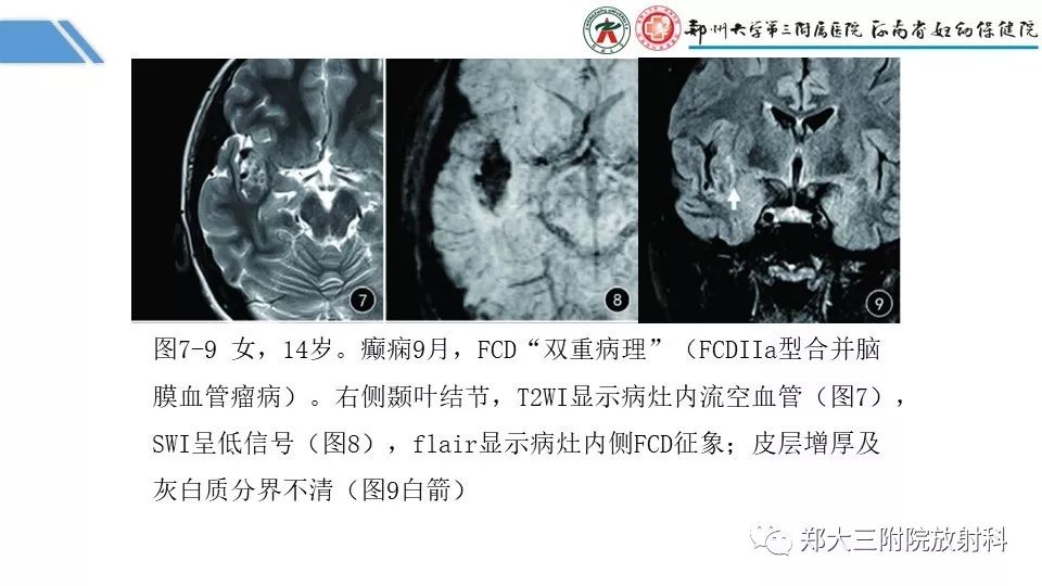 【PPT】局灶性脑皮层发育不良（FCD）