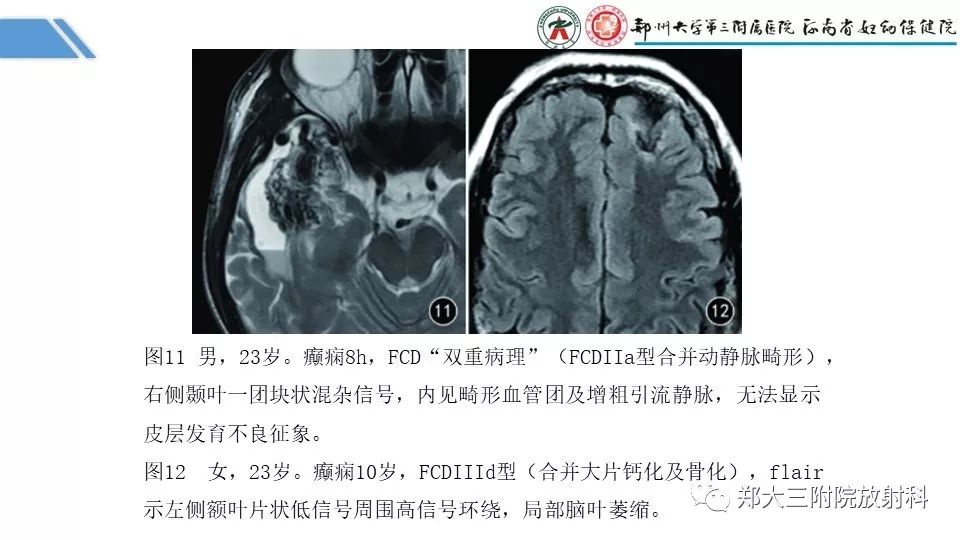 【PPT】局灶性脑皮层发育不良（FCD）