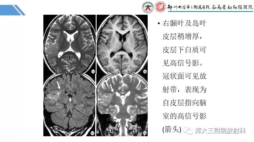 【PPT】局灶性脑皮层发育不良（FCD）