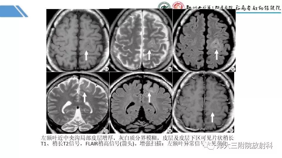 【PPT】局灶性脑皮层发育不良（FCD）