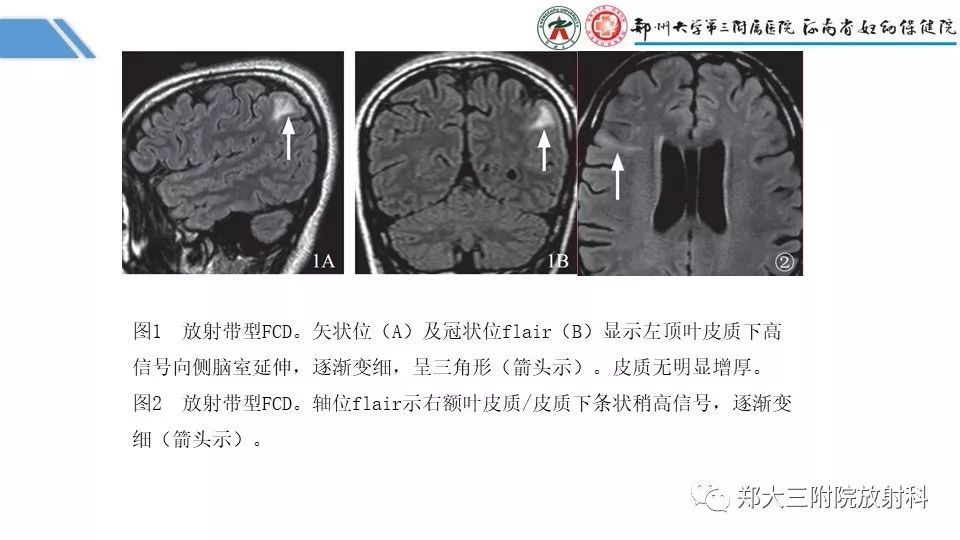 【PPT】局灶性脑皮层发育不良（FCD）