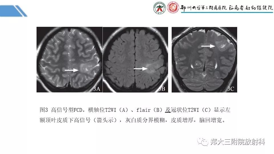 【PPT】局灶性脑皮层发育不良（FCD）