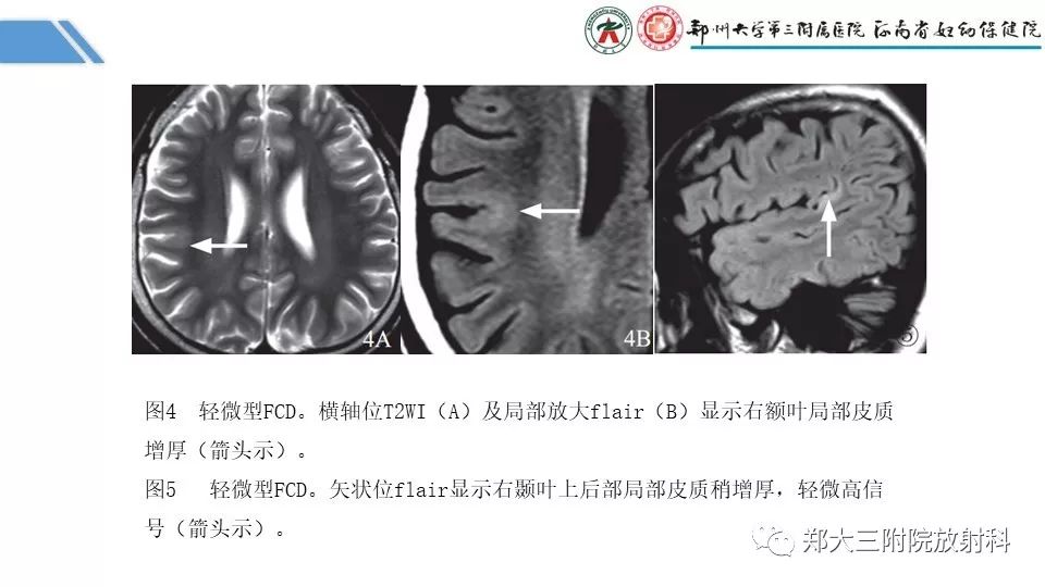 【PPT】局灶性脑皮层发育不良（FCD）