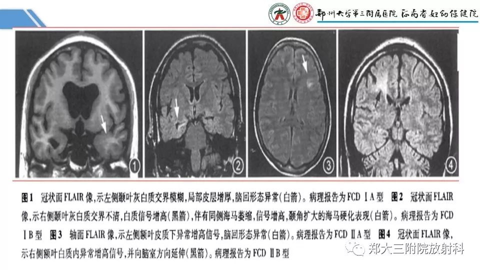 【PPT】局灶性脑皮层发育不良（FCD）